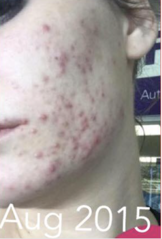 Cystic acneAcne treatment Cystic acne treatment How to get rid of cystic acne Adult acne Hormonal acne Severe acne Acne scars Cystic acne causes Skincare for cystic acne Natural remedies for cystic acne Lifestyle changes for cystic acne Dermatologist-recommended acne treatments Best products for cystic acne Managing cystic acne breakouts Preventing cystic acne flare-ups Cystic acne diet Effective skincare routine for cystic acne Cystic acne home remedies Mental health and cystic acne